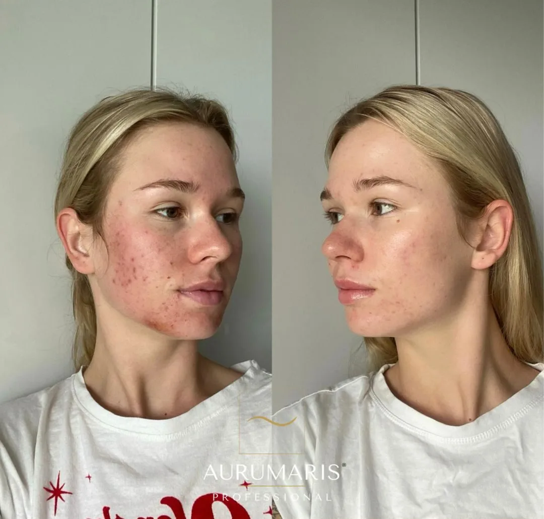 Acné et imperfections
